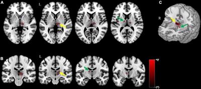 Gray Matter Volume of Thalamic Nuclei in Traumatized North Korean Refugees